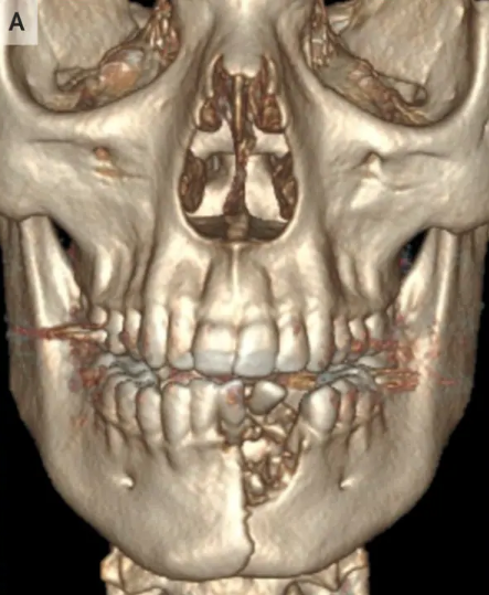 Sore Spot: Your Oral Surgeon Can Treat Scar Tissue in Your Mouth