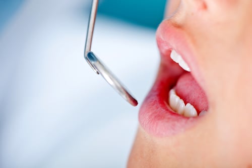 Close up of patients mouth in a visit to the dentist