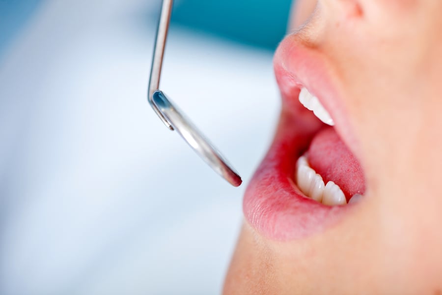 Close up of patients mouth in a visit to the dentist