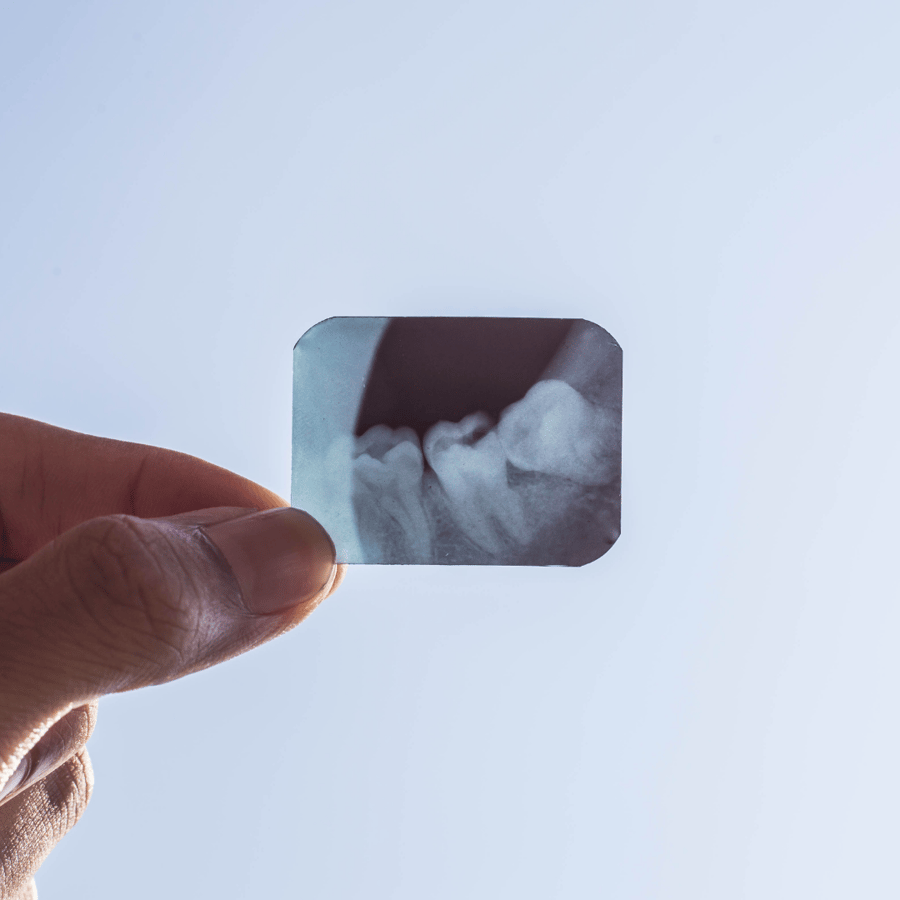 hand holding an x-ray film of an impacted tooth up to the light