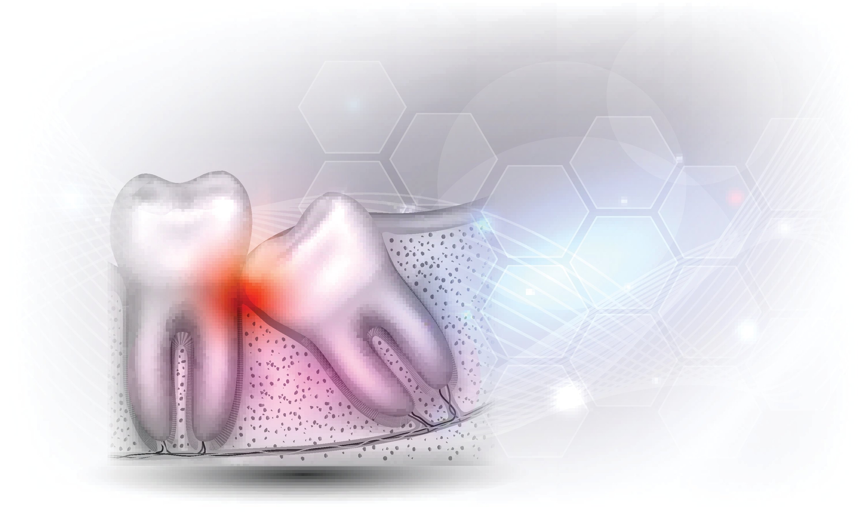 Wisdom tooth eruption illustrated anatomy