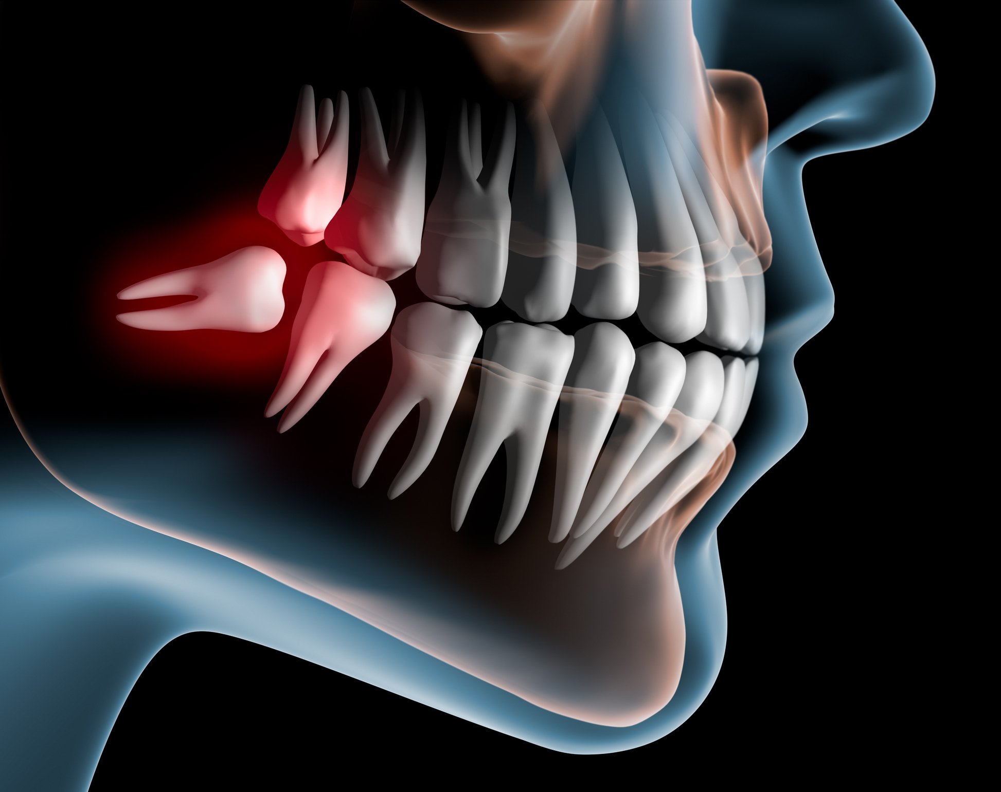 Lying wisdom tooth in the lower jaw
