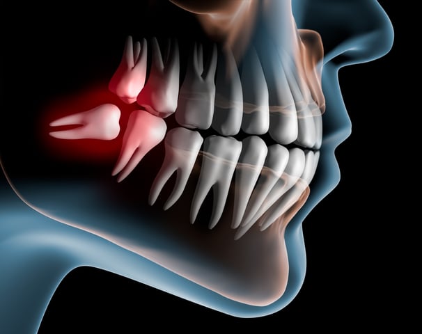 Lying wisdom tooth in the lower jaw