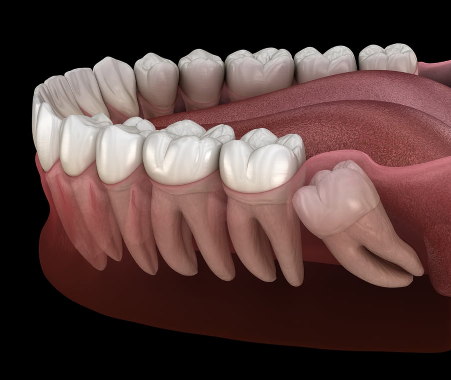 3D illustration of wisdom tooth with impaction at molar tooth