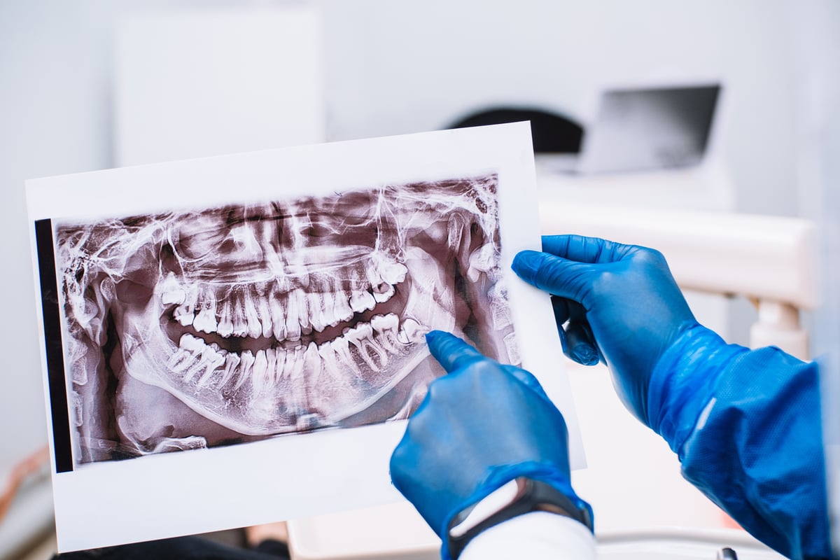 Doctor wearing latex gloves holding an oral x-ray of wisdom teeth