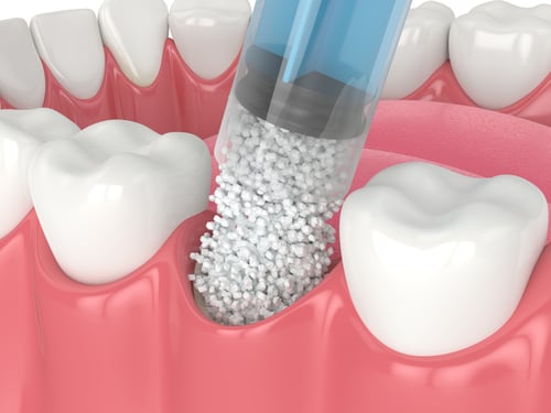 3D rendering of dental bone grafting