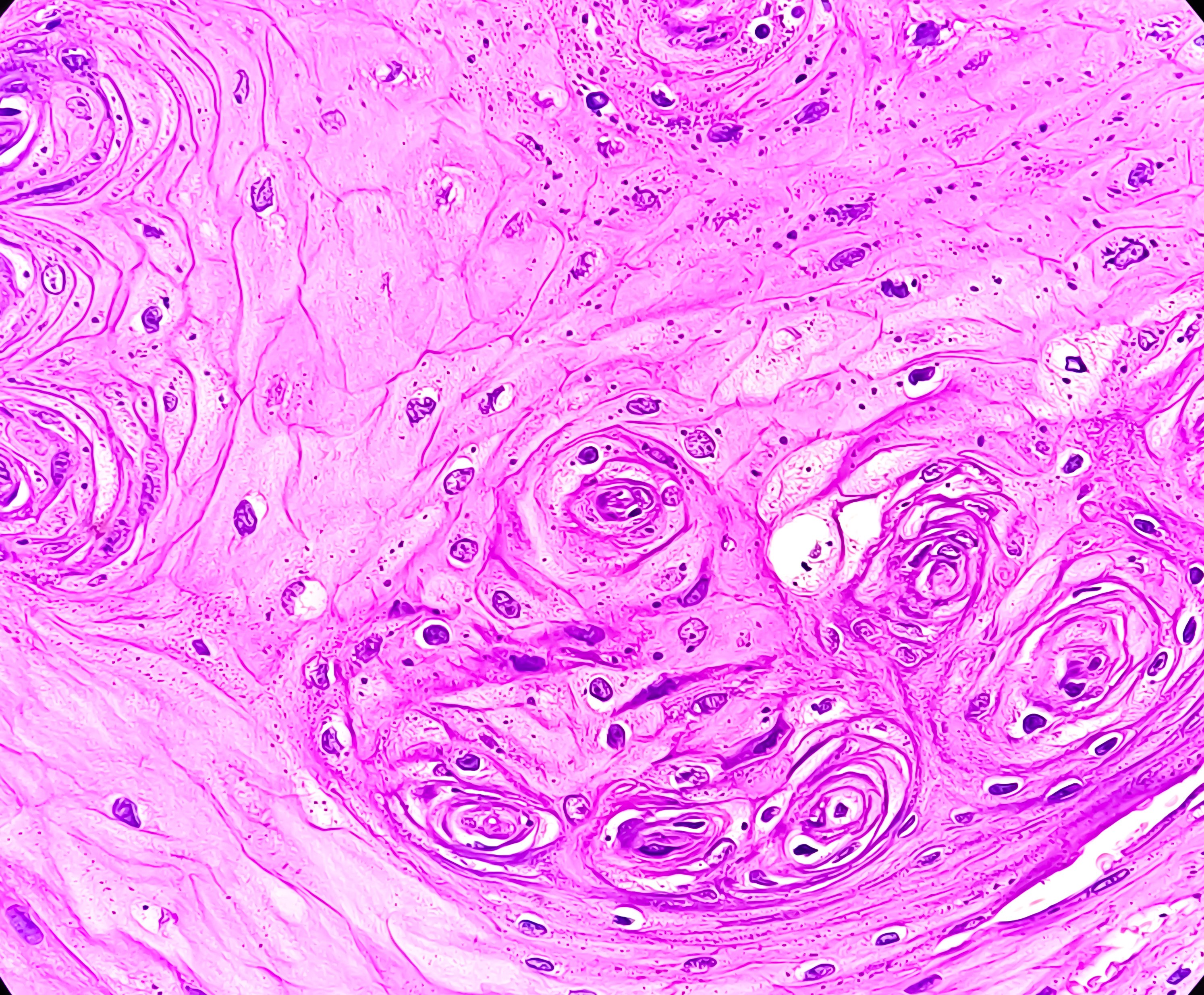 Microscopic examination showing Leukoplakia