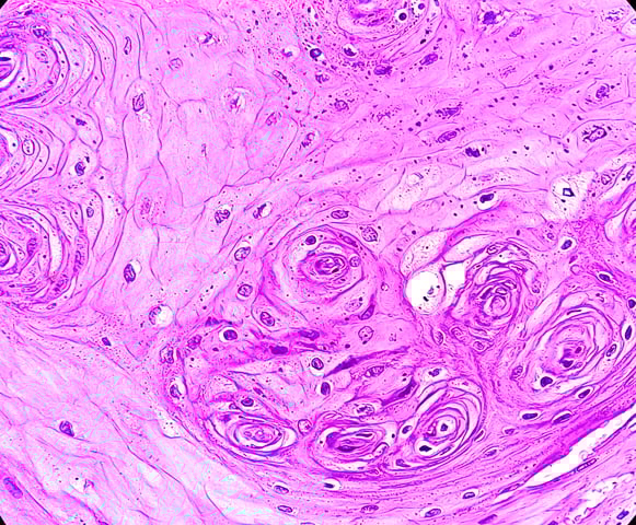 Microscopic examination showing Leukoplakia