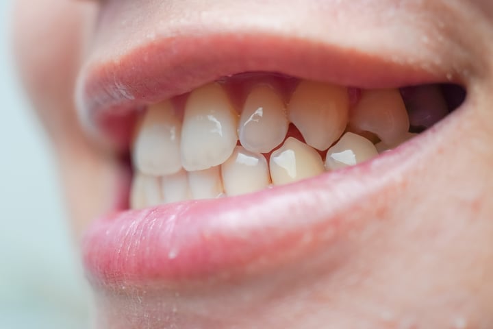 Close up photo of a woman's canine teeth