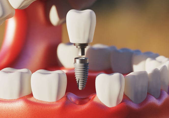 Illustration of dental implant screw