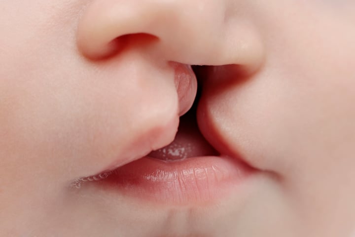 Close-up of baby with cleft lip