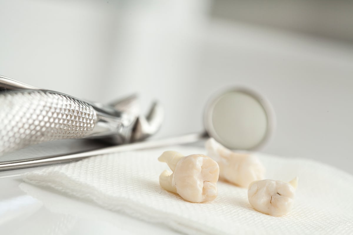 Removed wisdom tooth on table