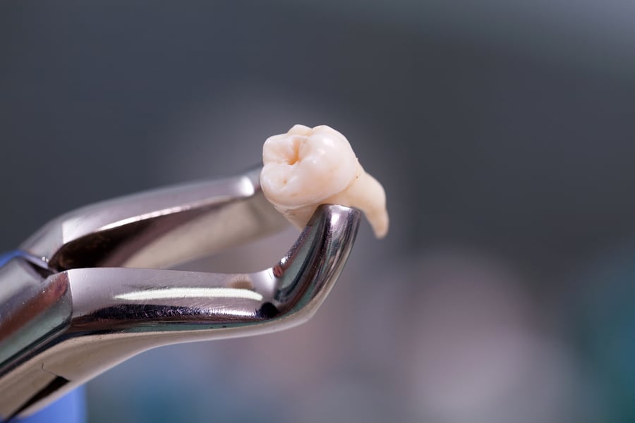 Dental equipment holding tooth from extraction