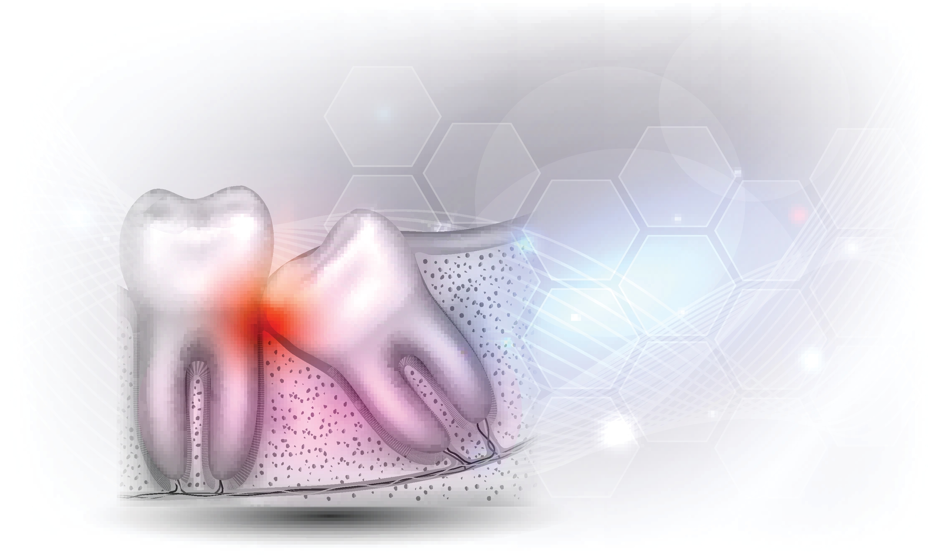 Wisdom tooth eruption illustrated anatomy